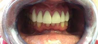 Before and After Invisalign Treatment Kingston