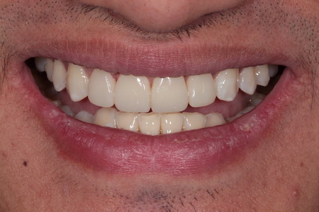 Before and After Invisalign Treatment Kingston