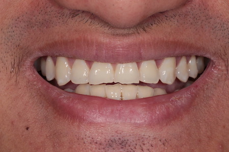 Before and After Invisalign Treatment Kingston