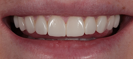 Before and After Bonding Treatment Kingston