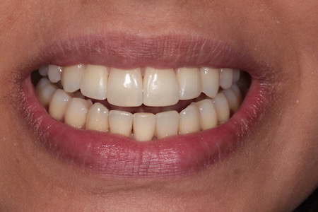 Before and After Invisalign Treatment Kingston