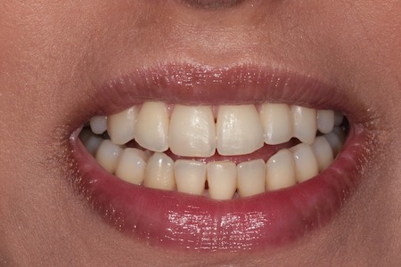 Before and After Invisalign Treatment Kingston