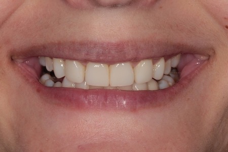 Before and After Invisalign Treatment Kingston