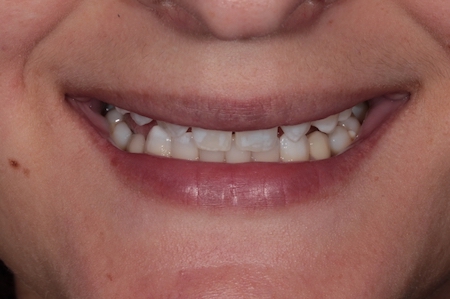 Before and After Invisalign Treatment Kingston