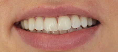 Before and After Invisalign Treatment Milton Keynes