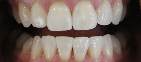 Before and After Invisalign Treatment Milton Keynes