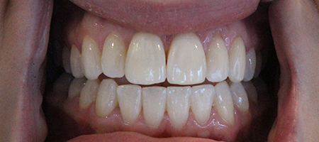 Before and After Invisalign Treatment Milton Keynes