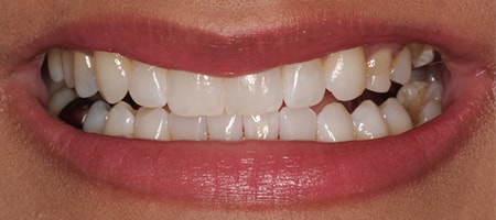 Before and After Invisalign Treatment Milton Keynes