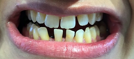 Before and After Invisalign Treatment Milton Keynes
