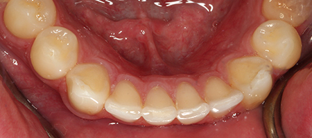 Before and After Invisalign Treatment Milton Keynes