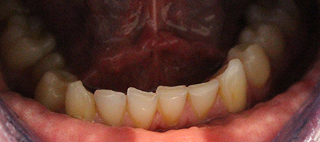 Before and After Invisalign Treatment Milton Keynes