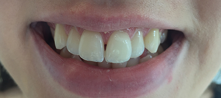 Before and After Invisalign Treatment Milton Keynes