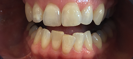 Before and After Invisalign Treatment Milton Keynes