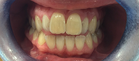 Before and After Invisalign Treatment Milton Keynes