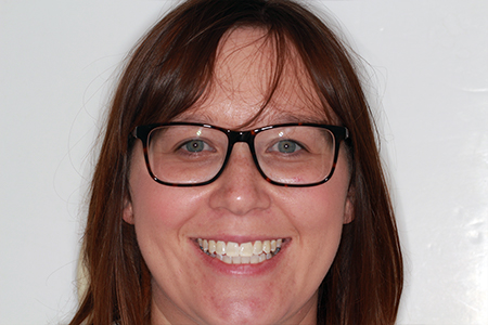 Before and After Invisalign Treatment Milton Keynes