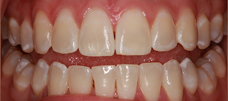 Before and After Invisalign Treatment Milton Keynes