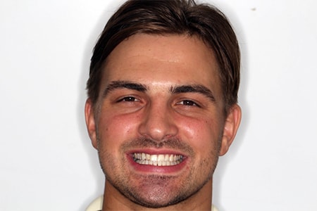 Before and After Invisalign Treatment Milton Keynes