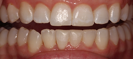 Before and After Invisalign Treatment Milton Keynes