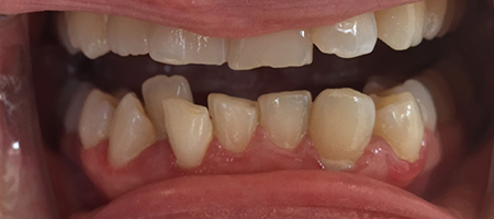 Before and After Invisalign Treatment Milton Keynes