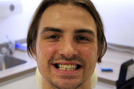 Before and After Invisalign Treatment Milton Keynes