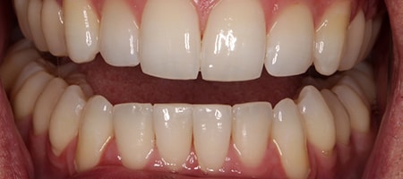 Before and After Invisalign Treatment Milton Keynes