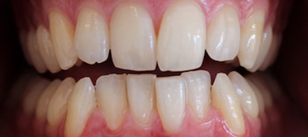 Before and After Invisalign Treatment Milton Keynes