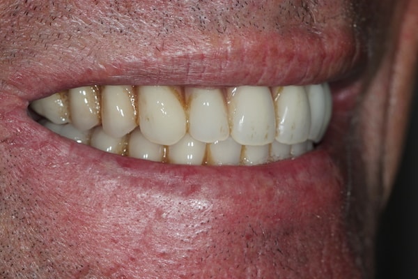 Before and After Invisalign Treatment Kingston
