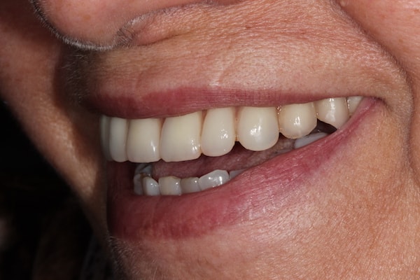 Before and After Invisalign Treatment Kingston