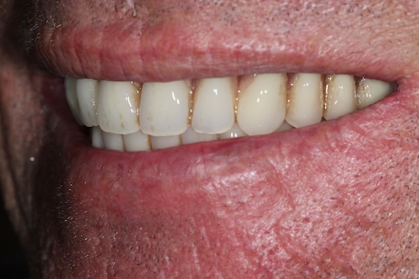 Before and After Invisalign Treatment Kingston