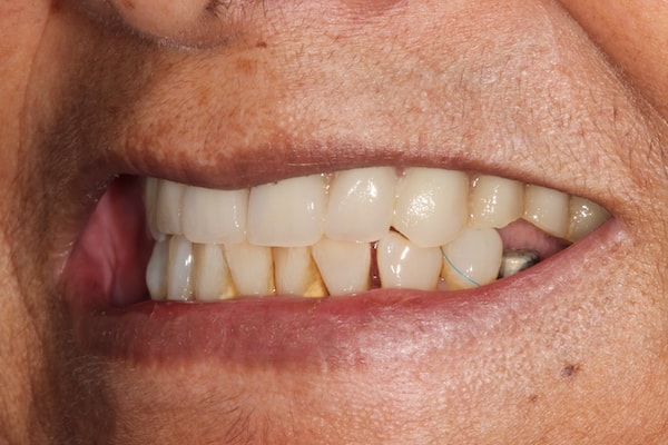 Before and After Invisalign Treatment Kingston
