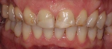 Before and After Invisalign Treatment Kingston