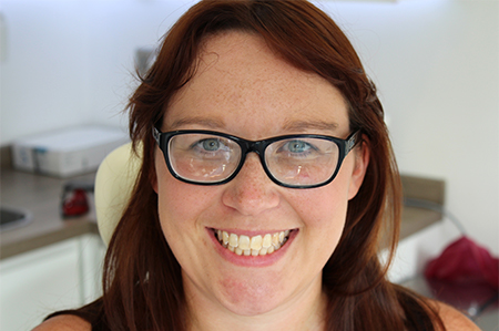 Before and After Invisalign Treatment Milton Keynes