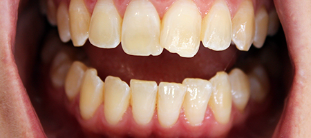 Before and After Invisalign Treatment Milton Keynes