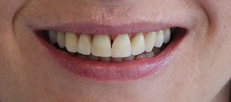 Before and After Invisalign Treatment Milton Keynes