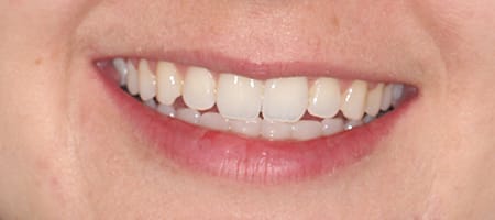 Before and After Invisalign Treatment Milton Keynes