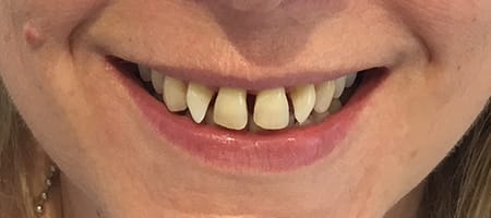 Before and After Invisalign Treatment Milton Keynes