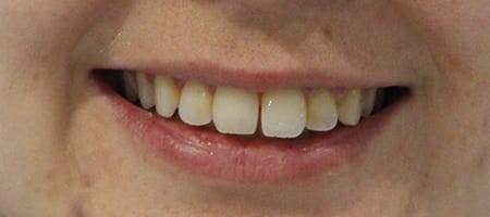 Before and After Invisalign Treatment Milton Keynes
