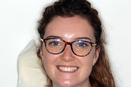 Before and After Invisalign Treatment Milton Keynes