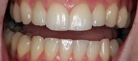 Before and After Invisalign Treatment Milton Keynes
