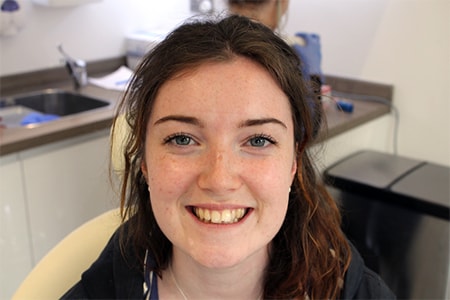 Before and After Invisalign Treatment Milton Keynes