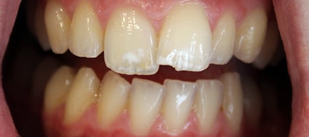Before and After Invisalign Treatment Milton Keynes