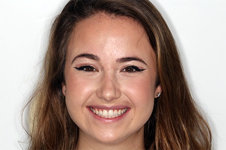Before and After Invisalign Treatment Milton Keynes