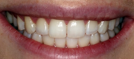 After Invisalign Treatment Milton Keynes