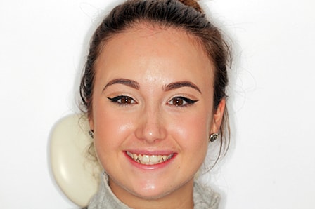 Before and After Invisalign Treatment Milton Keynes