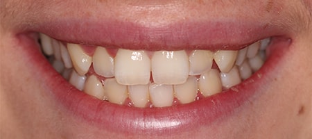 Before and After Invisalign Treatment Milton Keynes