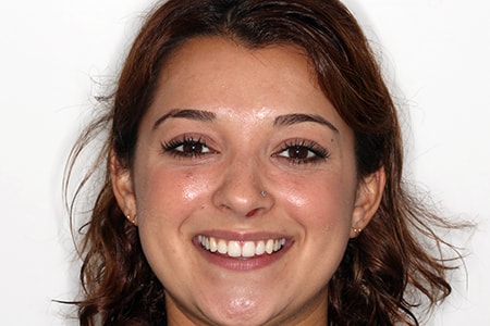 Before and After Invisalign Treatment Milton Keynes