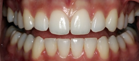 Before and After Invisalign Treatment Milton Keynes
