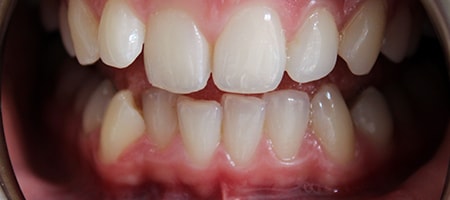 Before and After Invisalign Treatment Milton Keynes