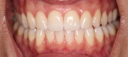 Before and After Invisalign Treatment Milton Keynes