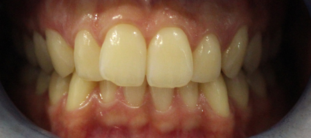 Before and After Invisalign Treatment Milton Keynes